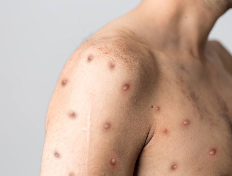 Lesiones cutáneas de viruela. Foto de Ilustración